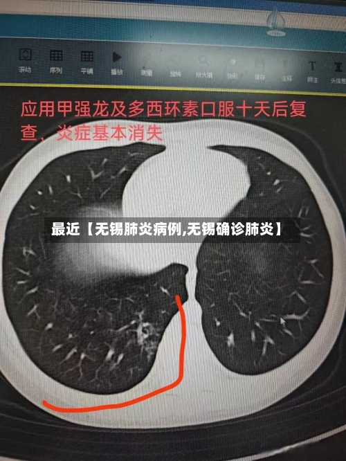 最近【无锡肺炎病例,无锡确诊肺炎】