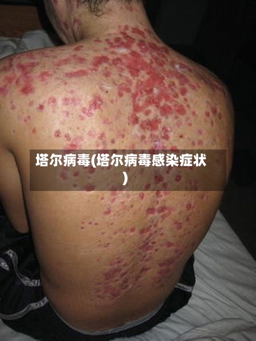 塔尔病毒(塔尔病毒感染症状)-第3张图片